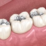 silver fillings, dental fillings, replacing fillings, mercury-free fillings, holistic dentistry, McKinney TX, dental care