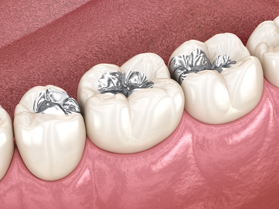 silver fillings, dental fillings, replacing fillings, mercury-free fillings, holistic dentistry, McKinney TX, dental care