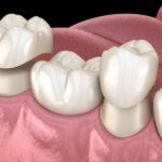 CEREC crowns, porcelain crowns, dental crowns, CEREC vs porcelain, crown options McKinney, dental restorations, crown comparison