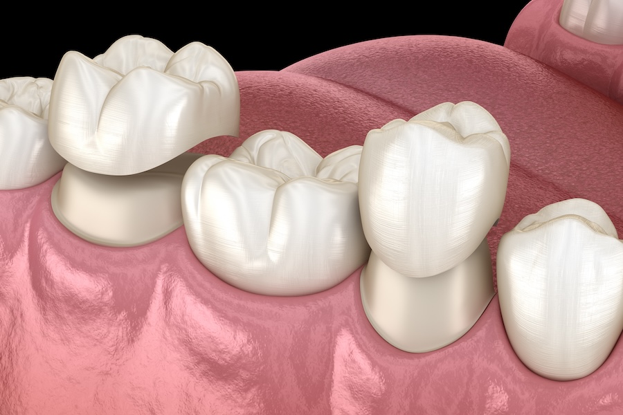 CEREC crowns, porcelain crowns, dental crowns, CEREC vs porcelain, crown options McKinney, dental restorations, crown comparison