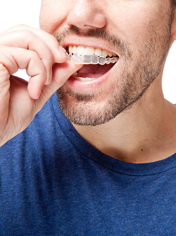 man putting a clear aligner onto his teeth