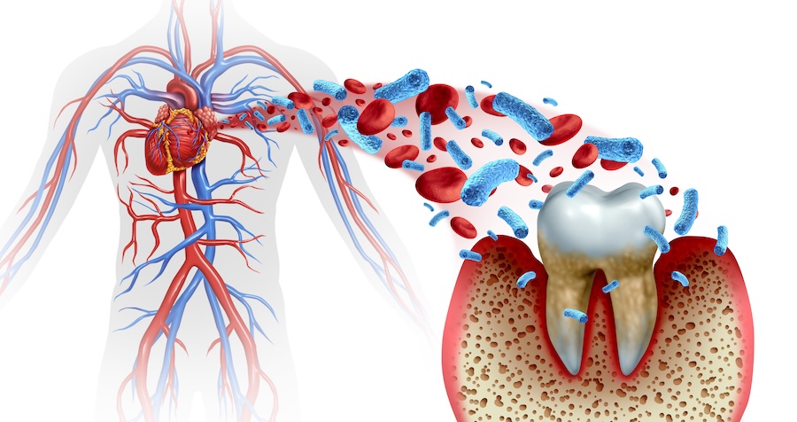 gum disease and inflammation affects whole body health, including heart health