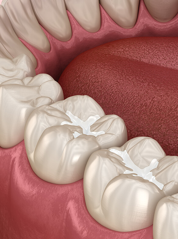 illustration of a tooth-colored filling
