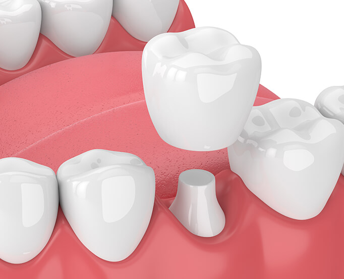 illustration of a dental crown