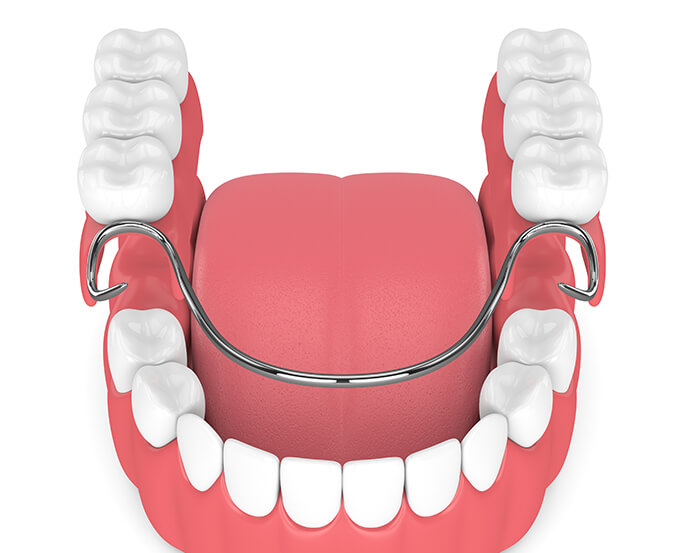 illustration of partial dentures