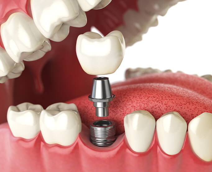 illustration of a dental implant